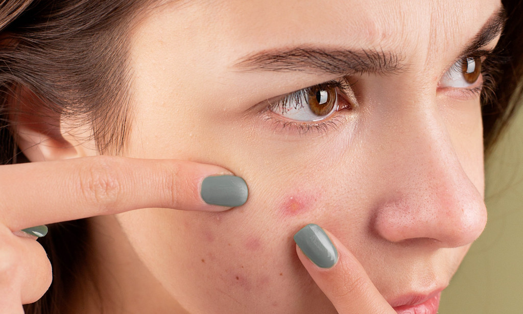 Acne Medicine Treatment Found In Natural Acne Products