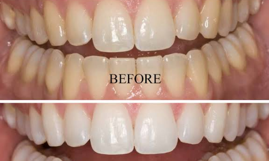 Home remedies for teeth whitening