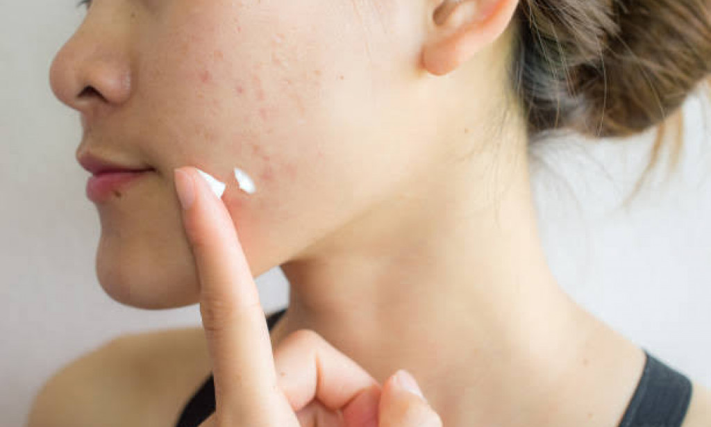 Ways of getting rid of Acne