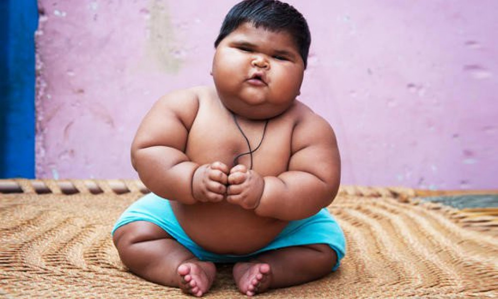 Obesity in children