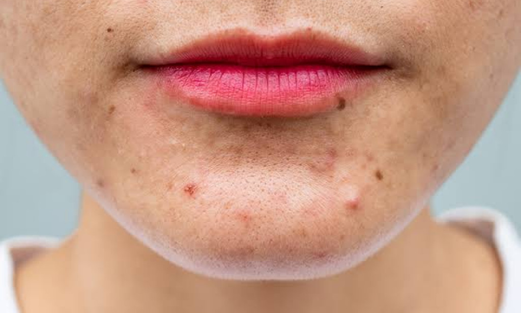 How to get rid of pimples naturally