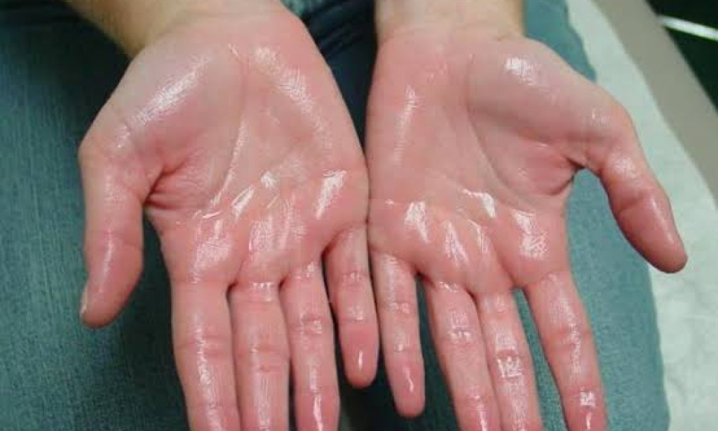 Hyperhidrosis definition