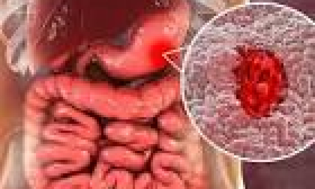 Basic Facts you should know about Stomach Ulcer