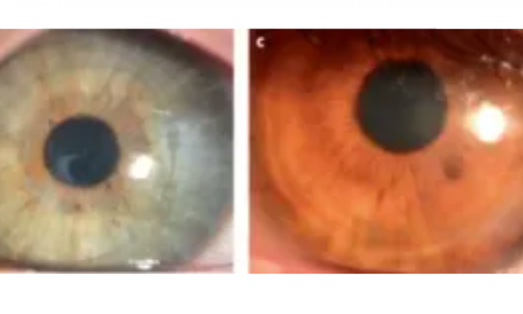 Blind patients who have an artificial cornea manufactured from pig skin cells can see.