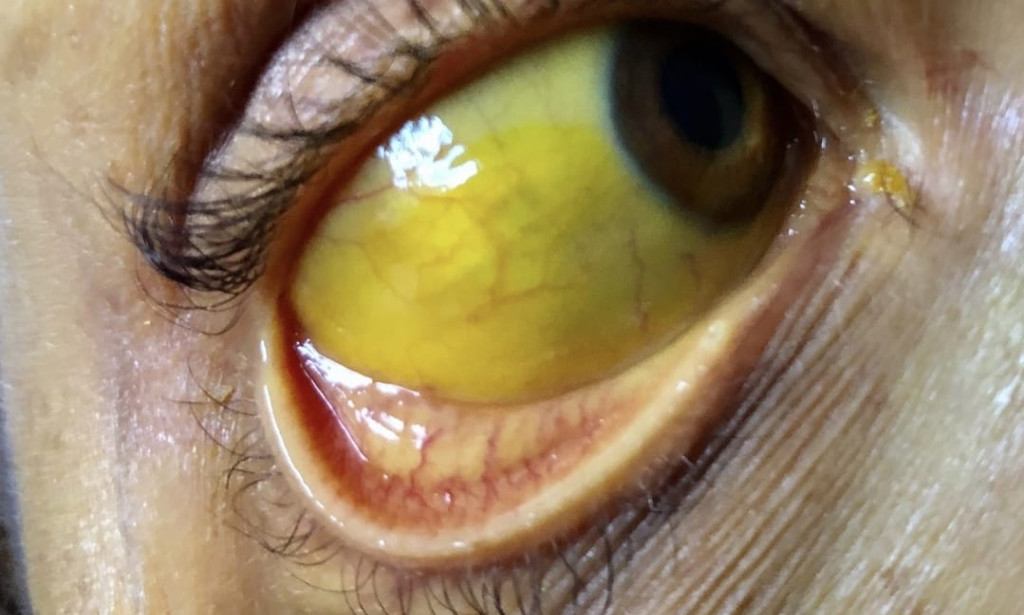 Hepatitis B  virus Disease