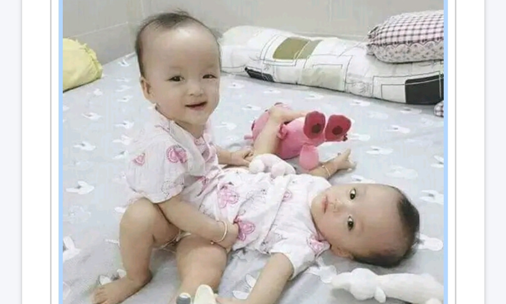 Conjoined Twins: A Rare but Fascinating Medical Phenomenon Explained