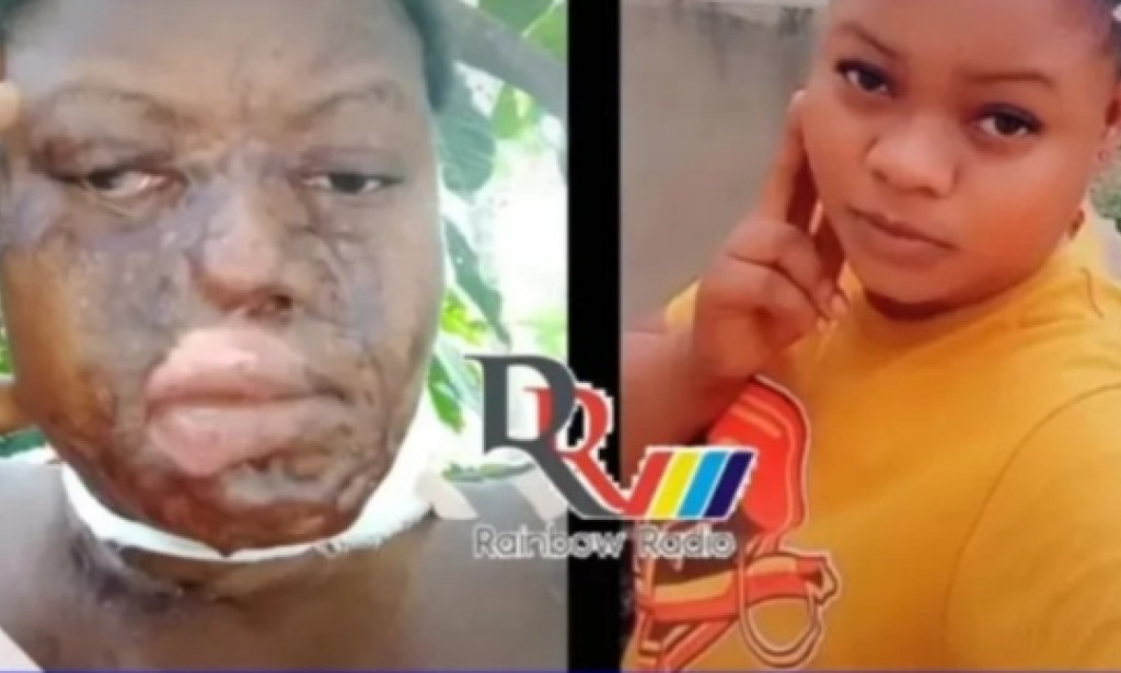 Young Woman Allegedly Attacked With Acid For Refusing The Proposal Of A Man