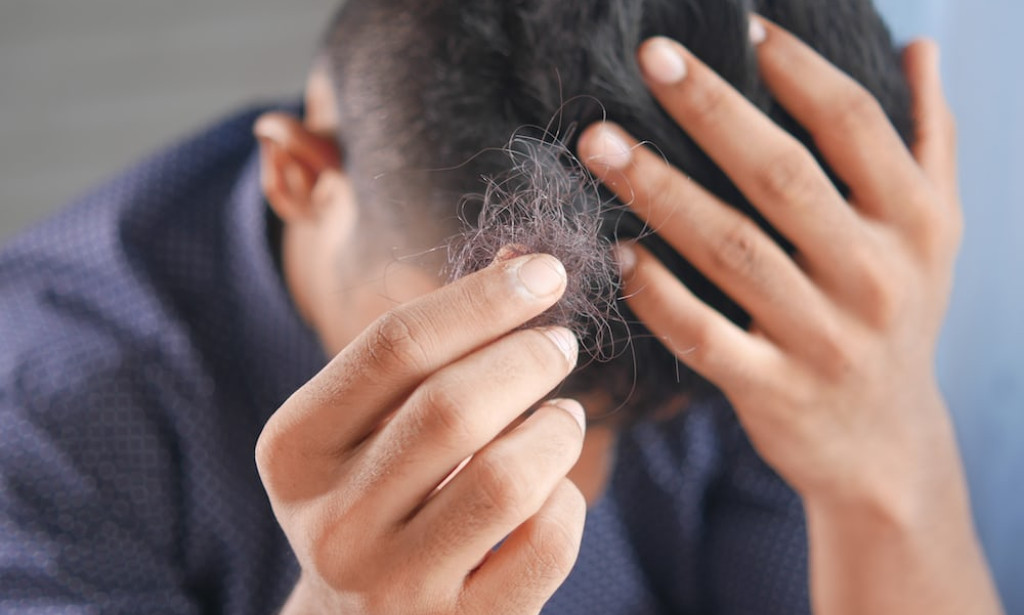BALD AND BOLD: ALOPECIA