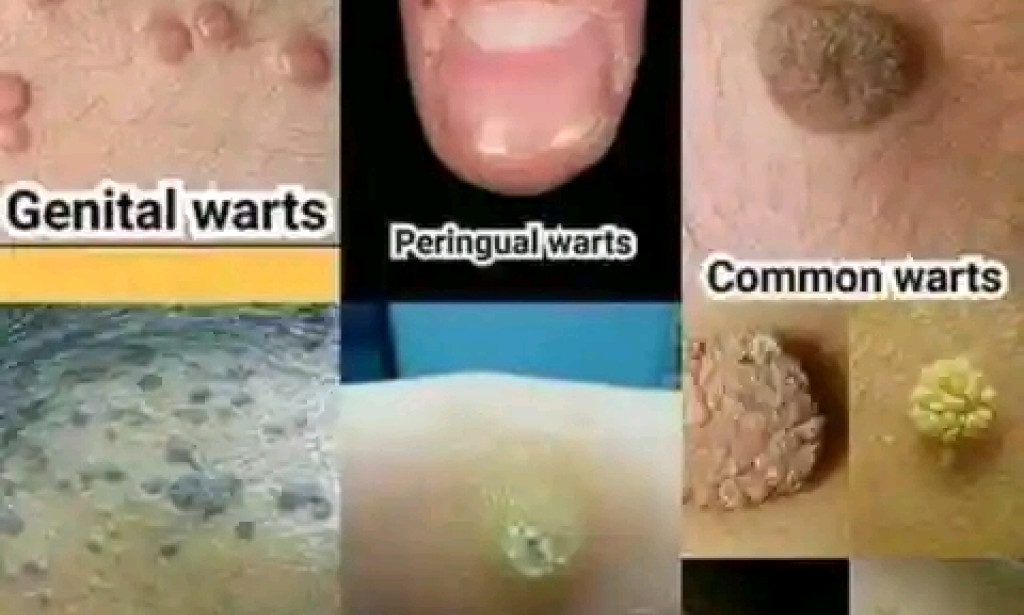 Remove warts and skin tags with easy few homemade remedies.
