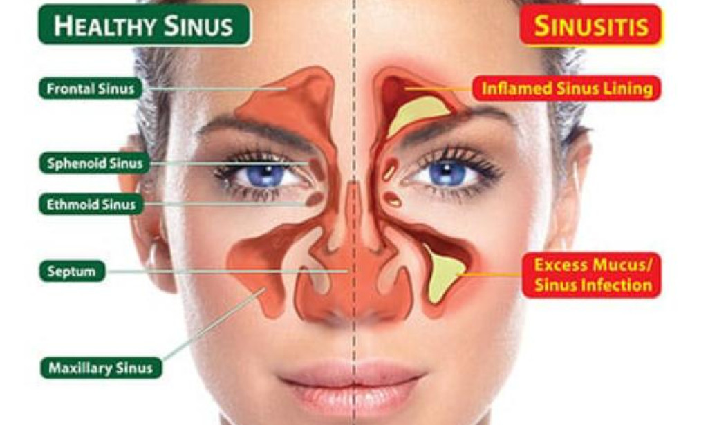 5 Natural Remedies for Sinus Infection Relief at Home