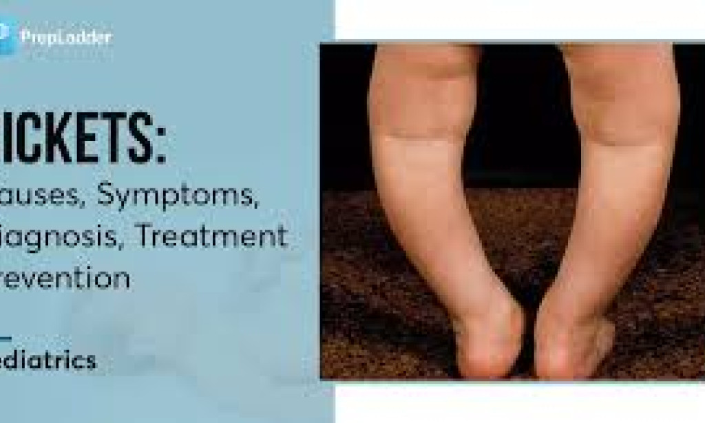 Rickets: How to identify and prevent your child from getting it